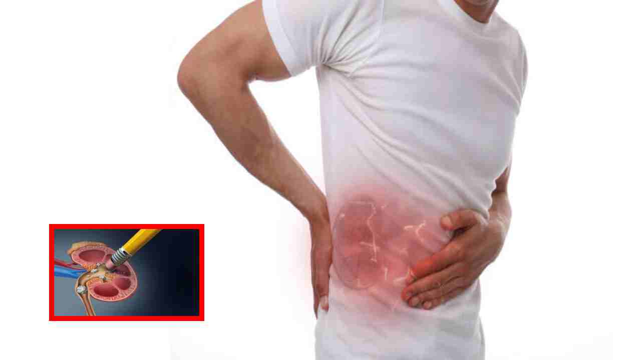 Kidney Stones : కిడ్నీల్లో రాళ్ల సమస్య రాకుండా ఉండాలంటే వీటికి దూరంగా ఉండటమే మంచిది!