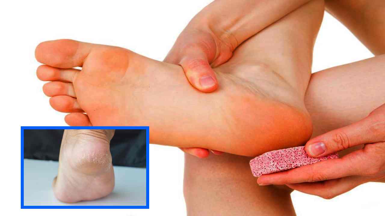 Cracked Heels : పాదాల పగుళ్ల సమస్యతో బాధపడుతున్నారా? పైనాపిల్ తో ఇలా చేసి చూడండి!