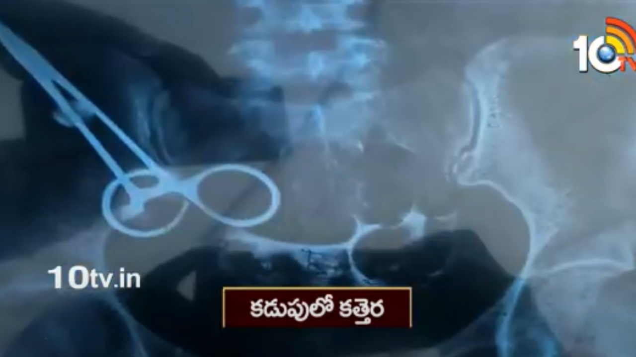 Doctor Negligence : ఆపరేషన్ అనంతరం కడుపులో కత్తెర మరిచిపోయిన డాక్టర్