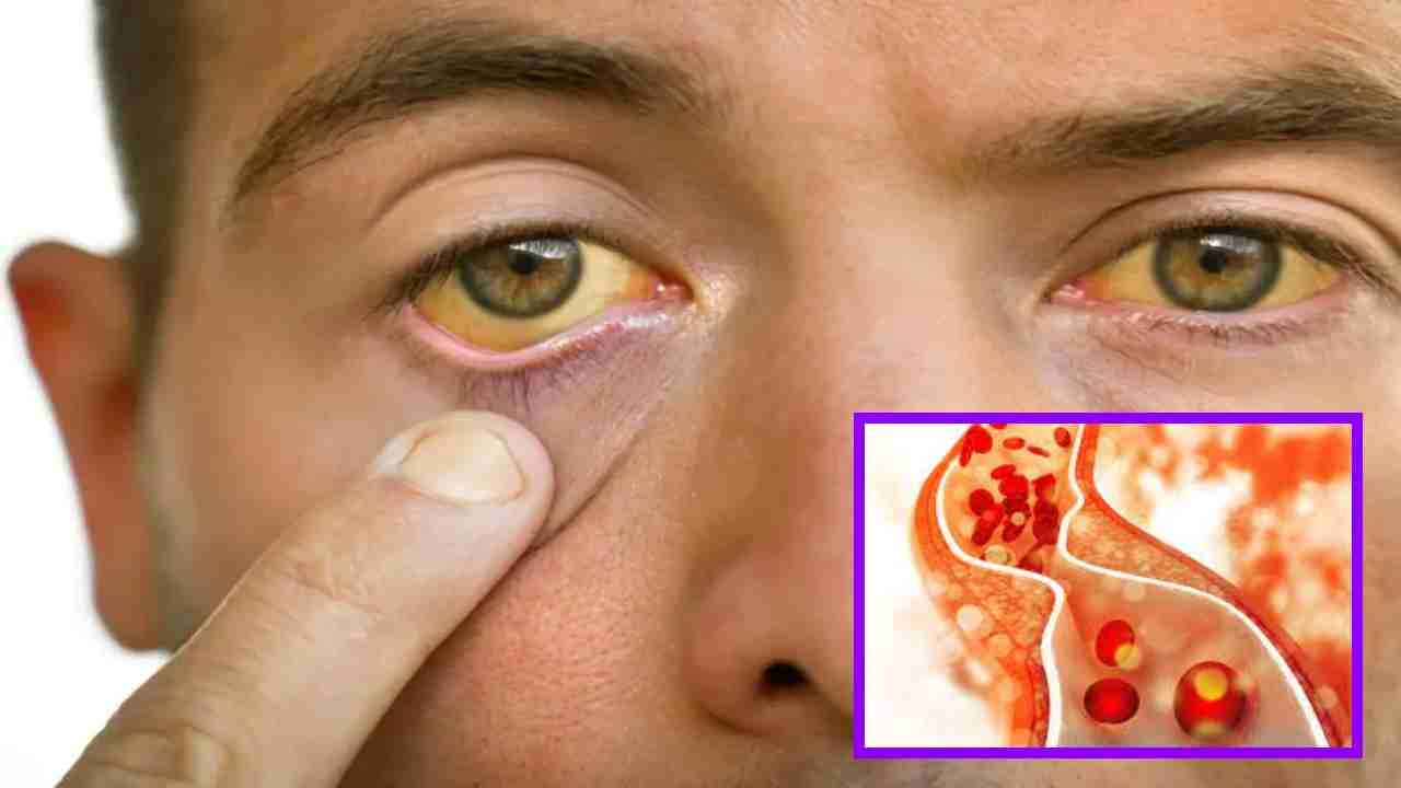 High Cholesterol Problem : అధిక కొలెస్ట్రాల్ సమస్య ఉంటే కనిపించే లక్షణాలు ఇవే !