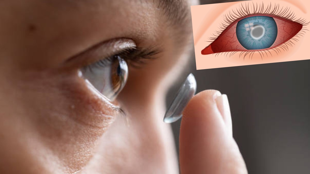 Contact Lenses : కాంటాక్ట్‌ లెన్స్‌ తీయకుండానే నిద్రపోటంతో కన్నునే పోగొట్టుకున్న యువకుడు