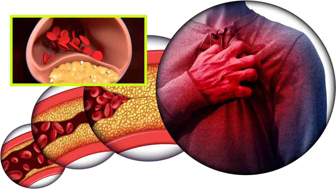 High Cholesterol : అధిక కొలెస్ట్రాల్ సమస్య గురించి కళ్లు, కాళ్ళు, నాలుకలో కనిపించే 5 సంకేతాలు !