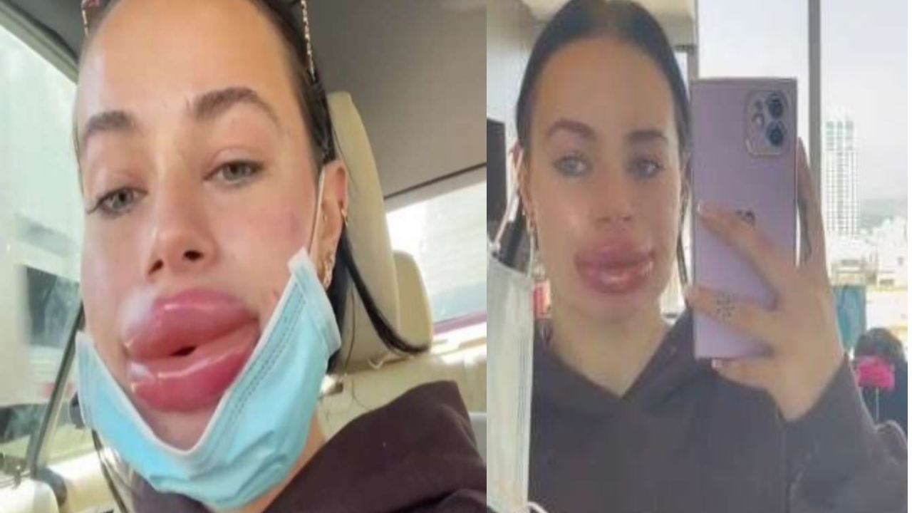 lip filler surgery : ఏదో కార్టూన్ పాత్ర అనుకునేరు.. లిప్ ఫిల్లింగ్ సర్జరీ ఫెయిలై ఇలా భయంకరంగా..