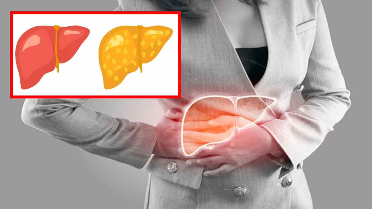 Fatty Liver Problem : ఫ్యాటీ లివర్ సమస్య మానసిక ఆరోగ్యాన్ని ఏవిధంగా ప్రభావితం చేస్తుందో తెలుసా ?
