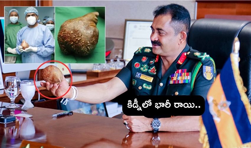 Sri Lanka  : మాజీ సైనికుడి కిడ్నీలో 801 గ్రాముల రాయి .. ఇదో ప్రపంచ రికార్డు