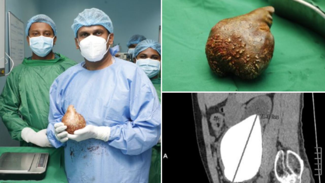 Heaviest kidney stone : 800 గ్రాముల కిడ్నీ స్టోన్ తొలగించిన శ్రీలంక వైద్యులు .. ప్రపంచ రికార్డులో నమోదైన కేసు