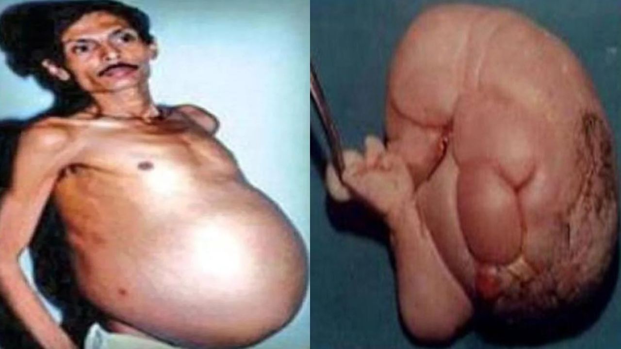 Mumbai : ‘ప్రెగ్నెంట్ మ్యాన్’.. నిజంగానే అతని కడుపులో కవలలు ఉన్నట్లు గుర్తించిన డాక్టర్లు