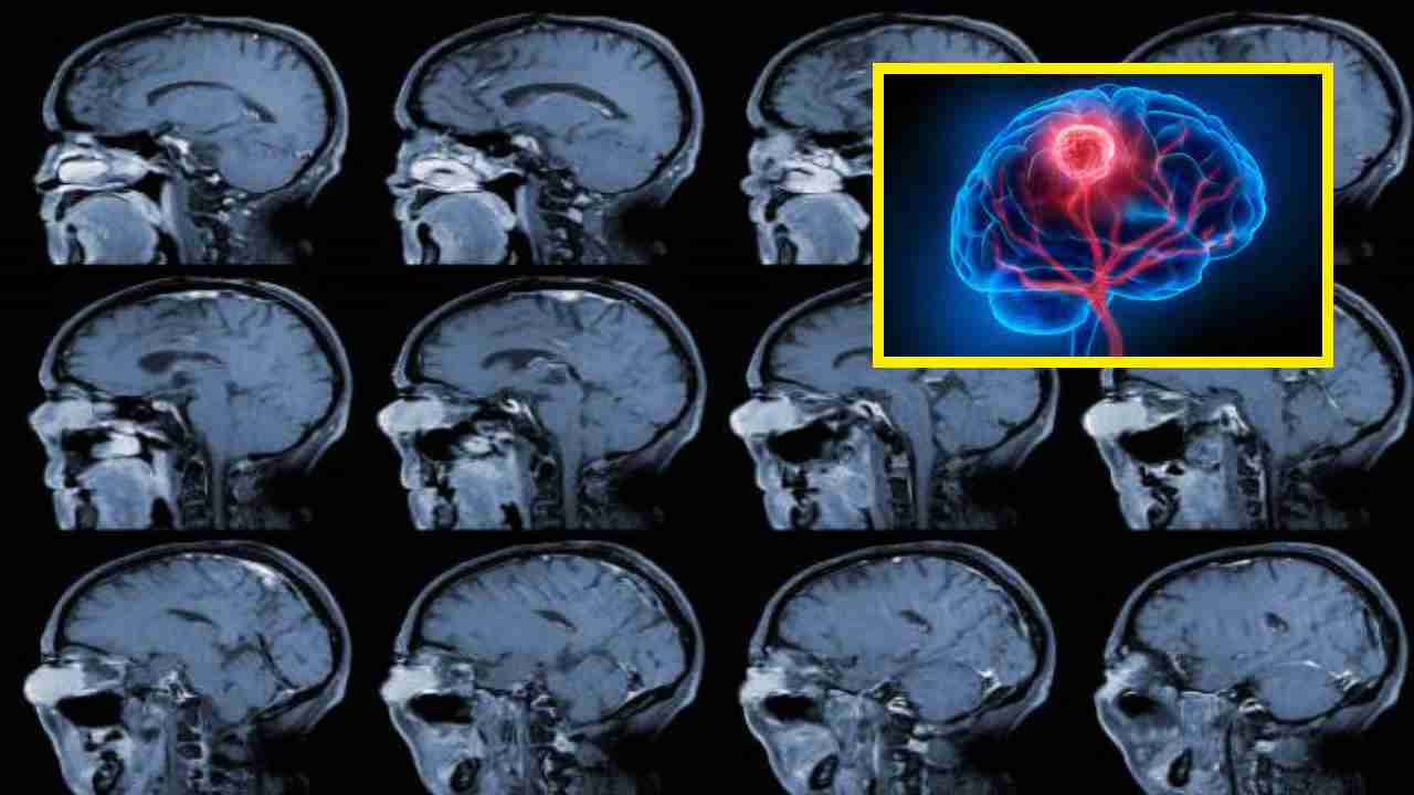 Brain Cancer : మెదడు క్యాన్సర్‌కు ప్రమాద కారకాలు, లక్షణాలు, నివారణలు !