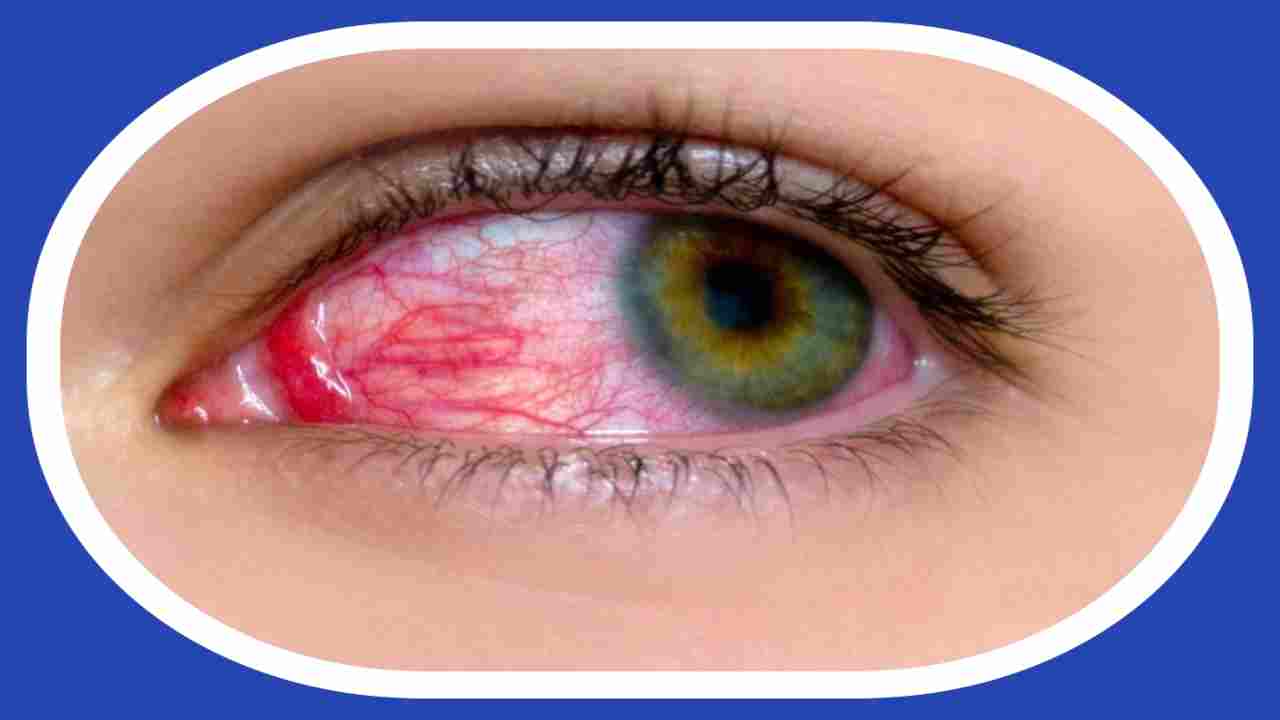 Conjunctivitis Scare : వేగంగా వ్యాప్తి చెందుతున్న కండ్లకలక.. ప్రయాణసమయాల్లో తీసుకోవాల్సిన జాగ్రత్తలు !
