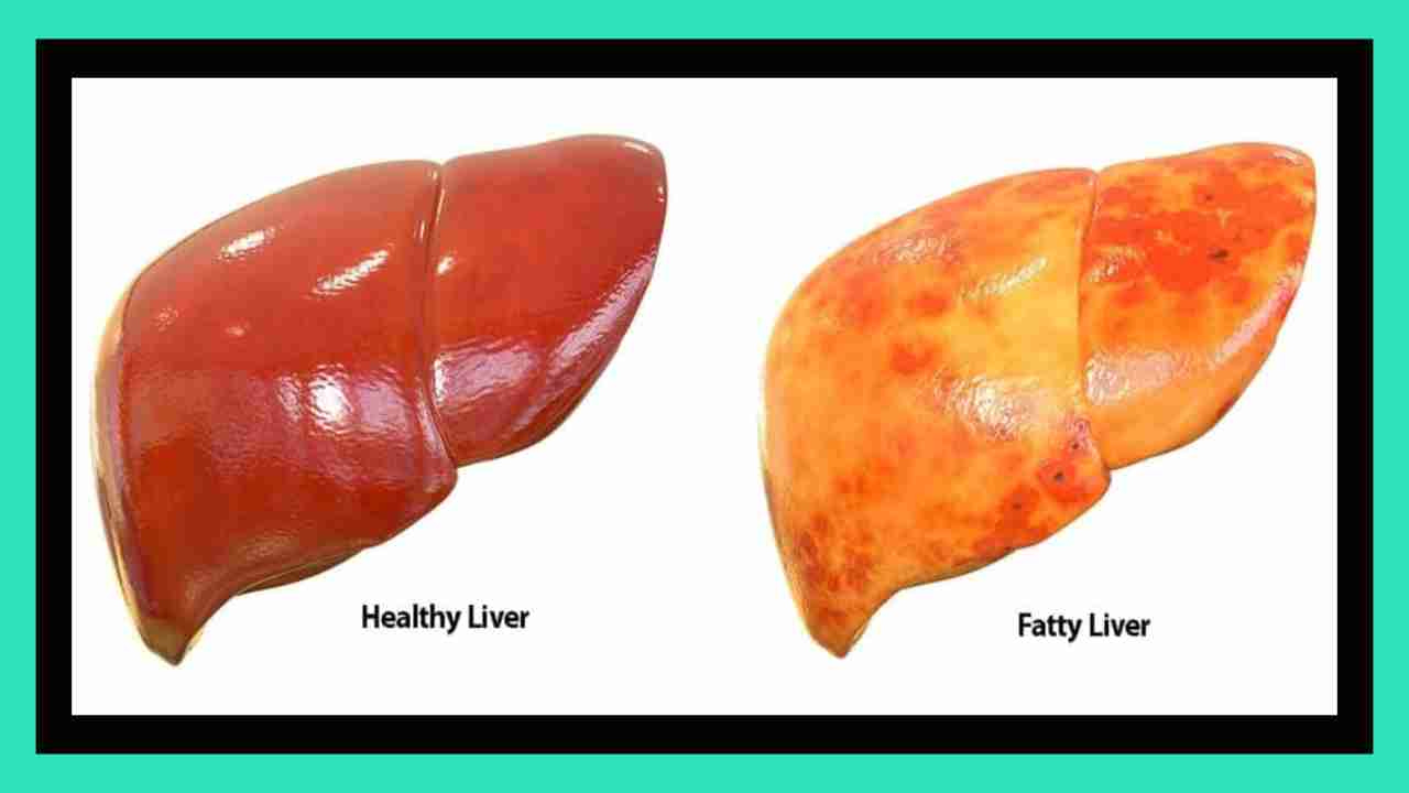 Fatty Liver Disease : శరీర భాగాల్లో ఈ 5 ప్రదేశాల్లో వాపు వస్తే అది ఫ్యాటీ లివర్ వ్యాధికి సంకేతమా !