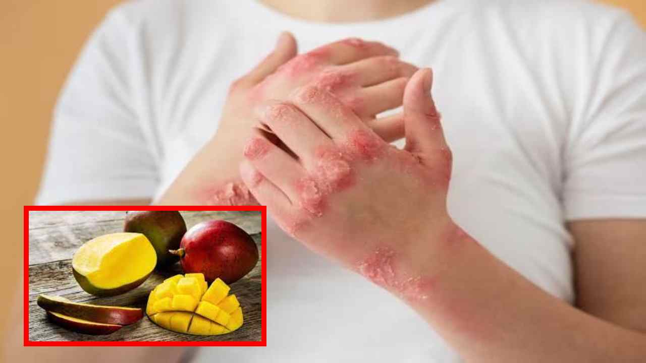 Skin Allergies : మామిడి పండు చర్మానికి అలెర్జీని కలిగిస్తుందా?