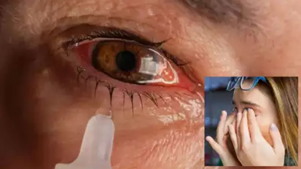 Eye Flu: భారీ వర్షాలతో విజృంభిస్తున్న కంటి ఫ్లూ.. లక్షణాలు ఏంటి? మిమ్మల్ని మీరు ఎలా కాపాడుకోవాలో తెలుసుకోండి