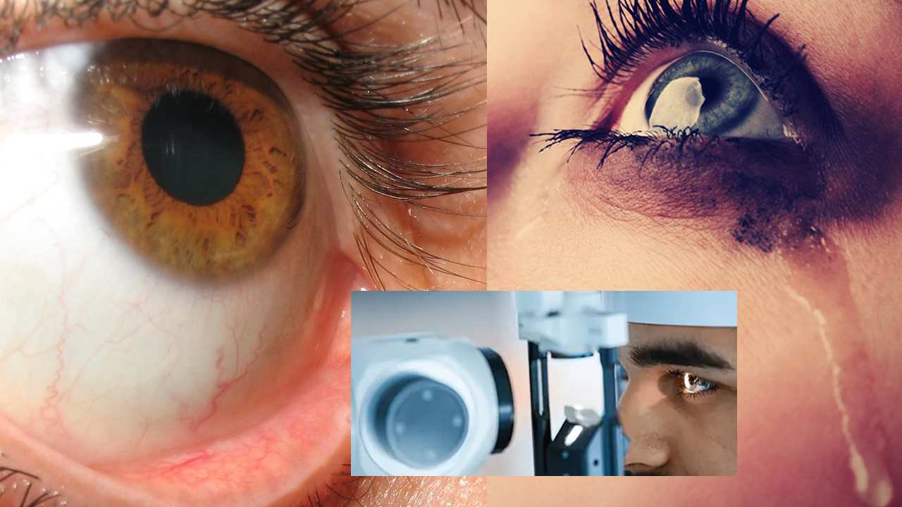 Watery Eyes: కంట్లోంచి నీరు కారుతుందా.. పెద్ద కారణమే ఉండొచ్చు.. ముందే జాగ్రత్త పడండి