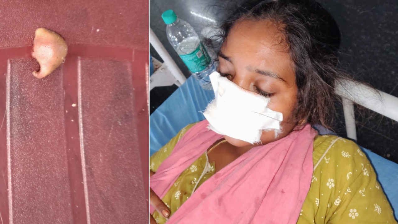Husband Bites Wife Nose : వీడెక్కడి మొగుడండీ బాబు..! భార్య ముక్కును కొరికి పక్కన పడేశాడు.. పుట్టింటికి వెళ్లడంతో..